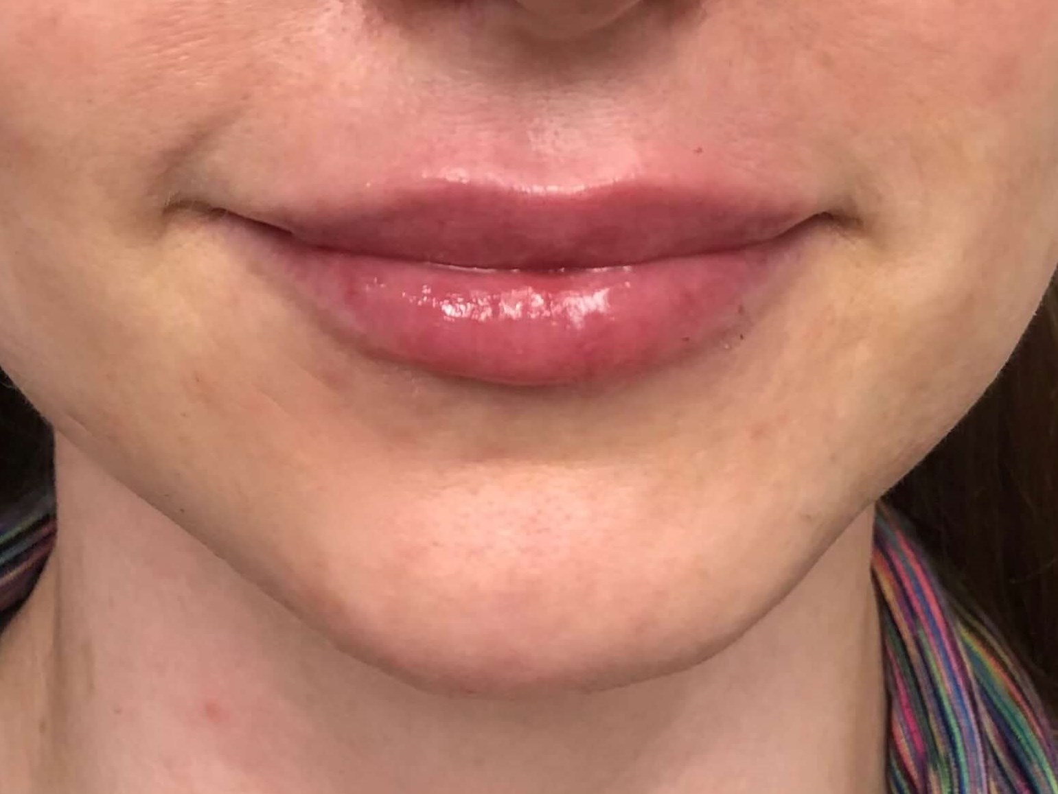 Juvederm Lip Enhancement After