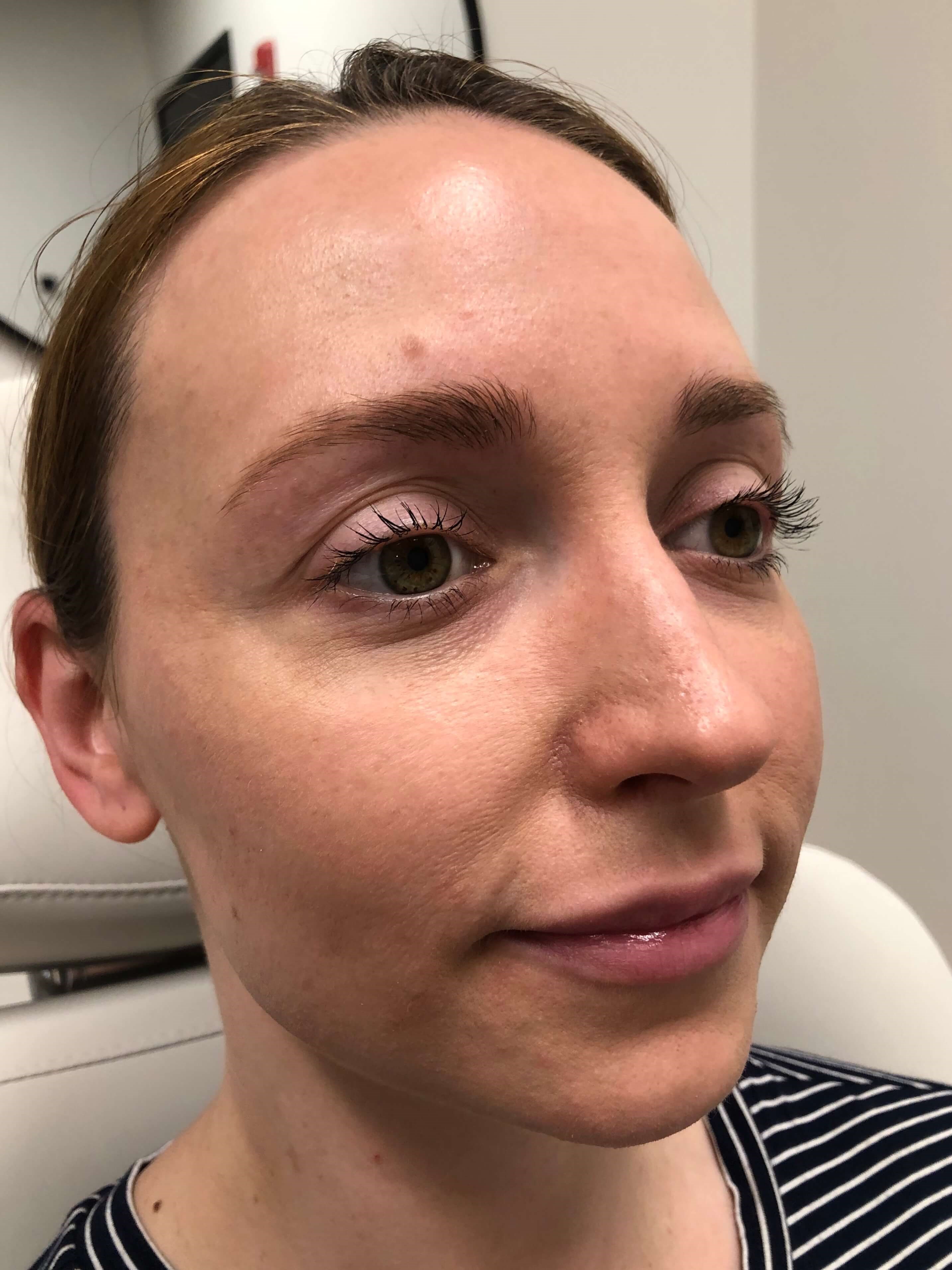 Juvederm Lip Enhancement Before