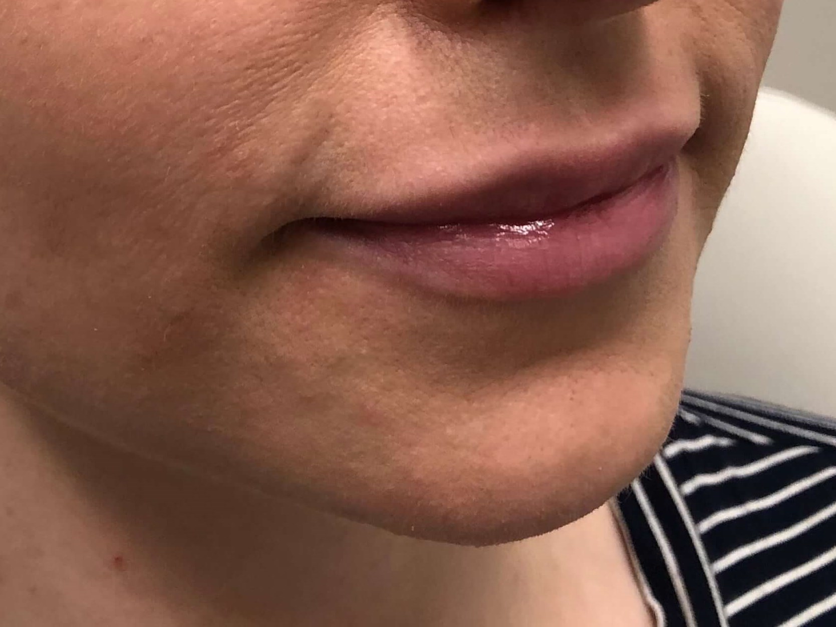 Juvederm Lip Enhancement Before