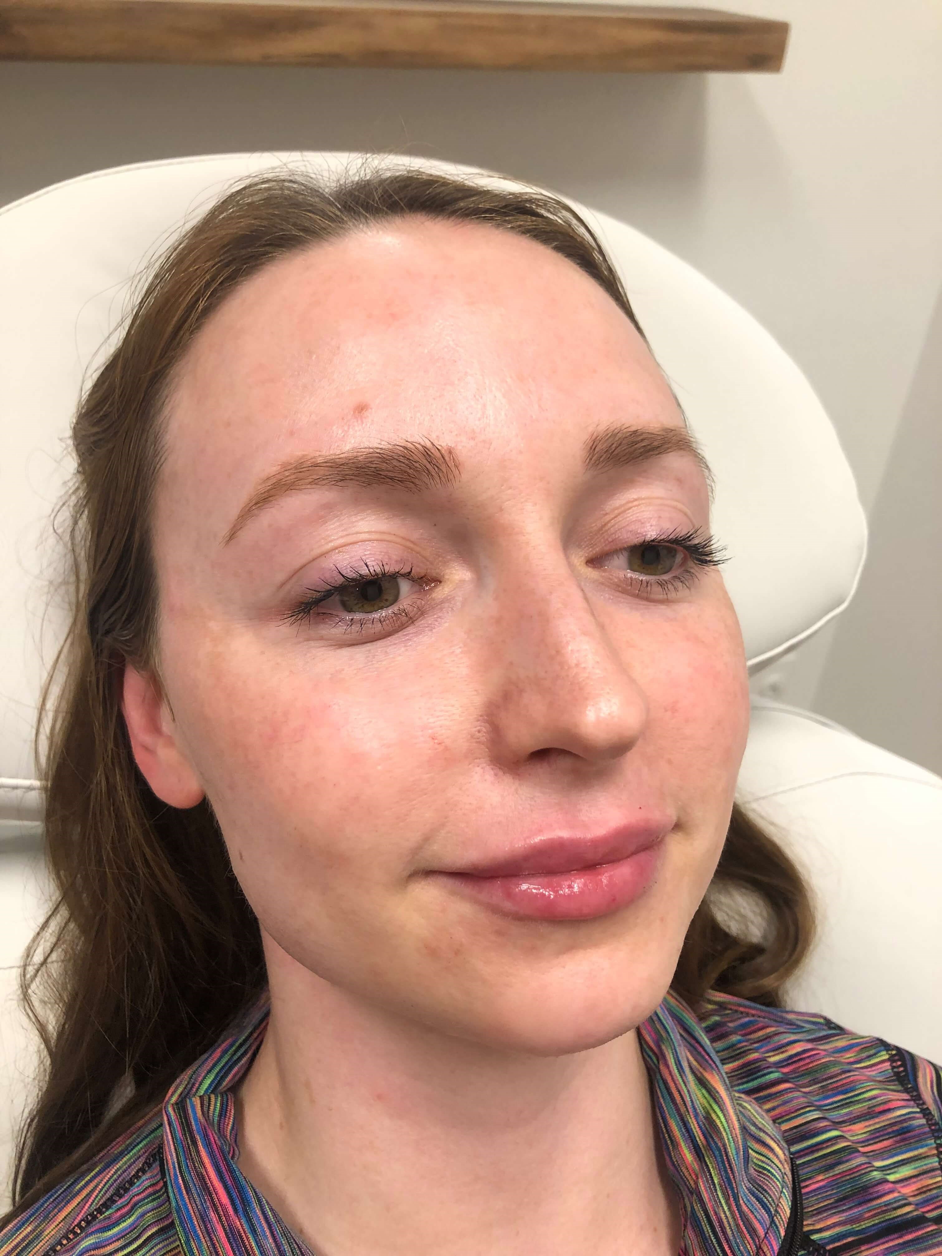 Juvederm Lip Enhancement After