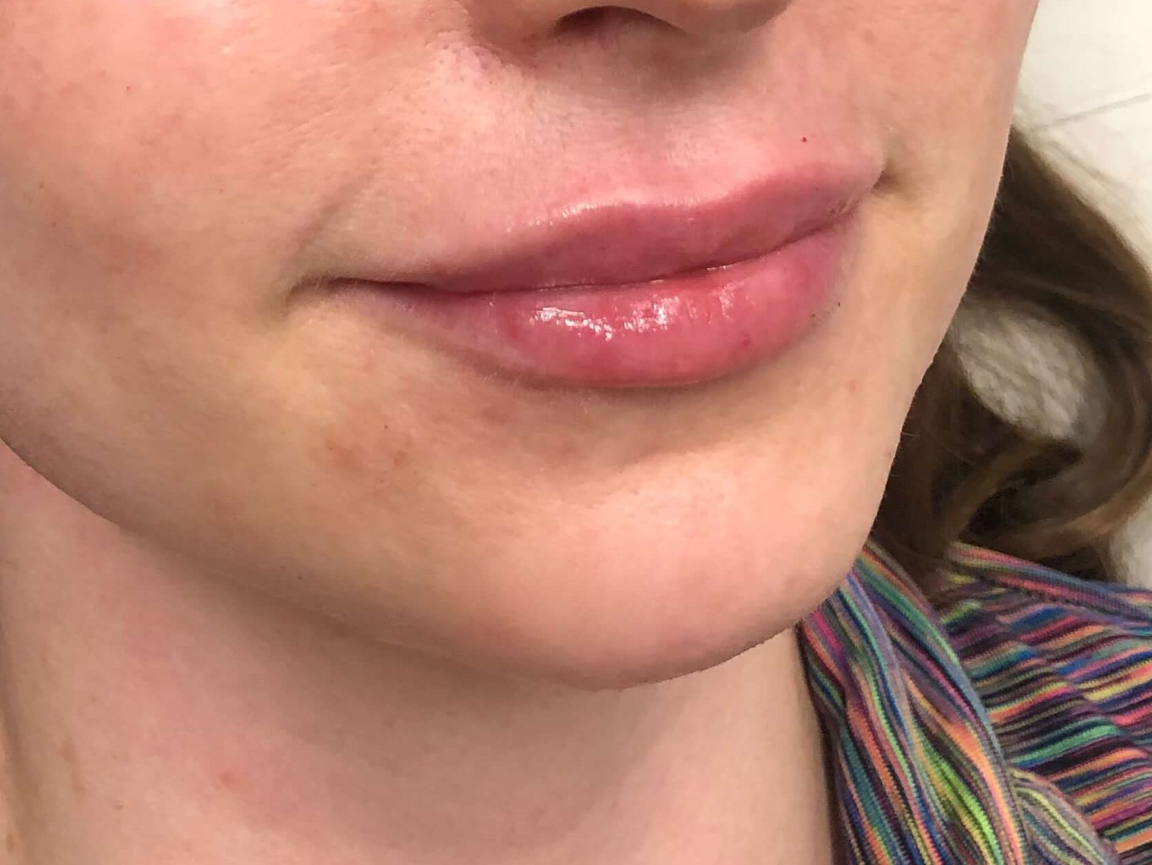 Juvederm Lip Enhancement After