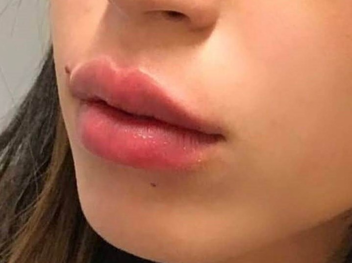 Juvederm Lip Enhancement After