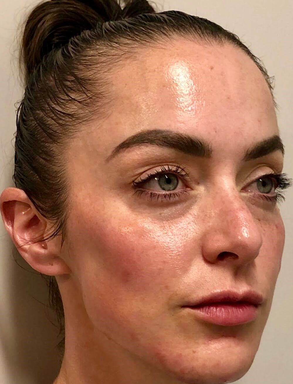 Restylane Cheek Fillers After