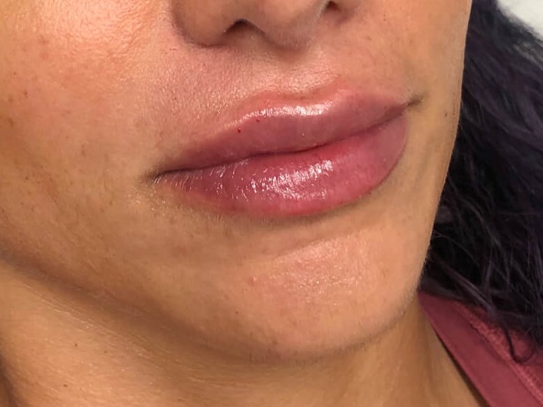 Juvederm Ultra Lips Female After