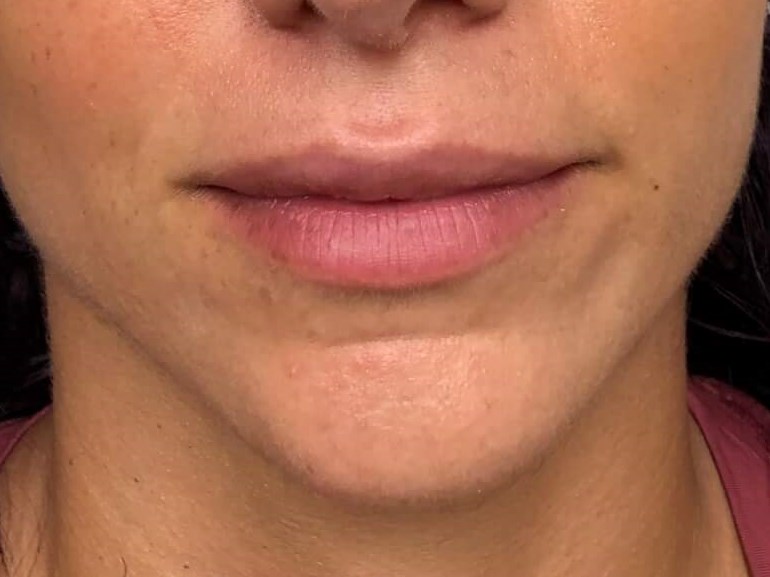 Juvederm Ultra Lips female Before