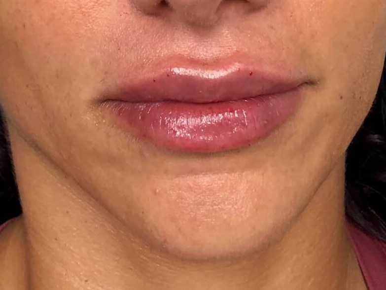 Juvederm Ultra Lips female After