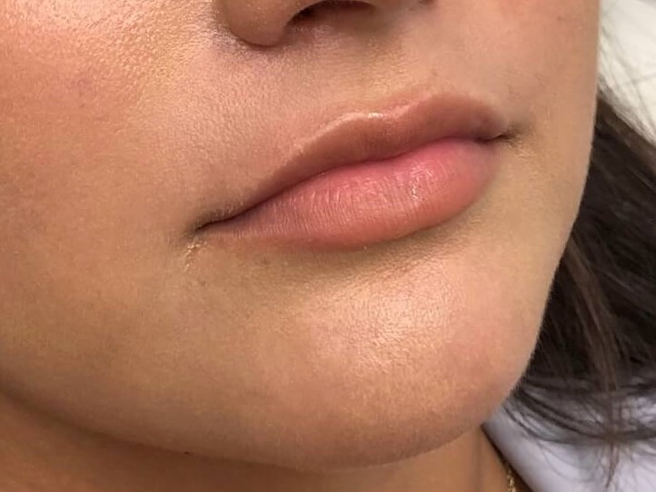 Restylane Kysse Lips Before