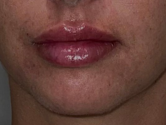 Restylane Kysse lip fillers After