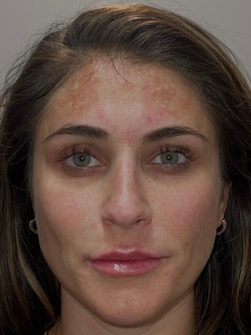 Restylane Kysse Lip Fillers After