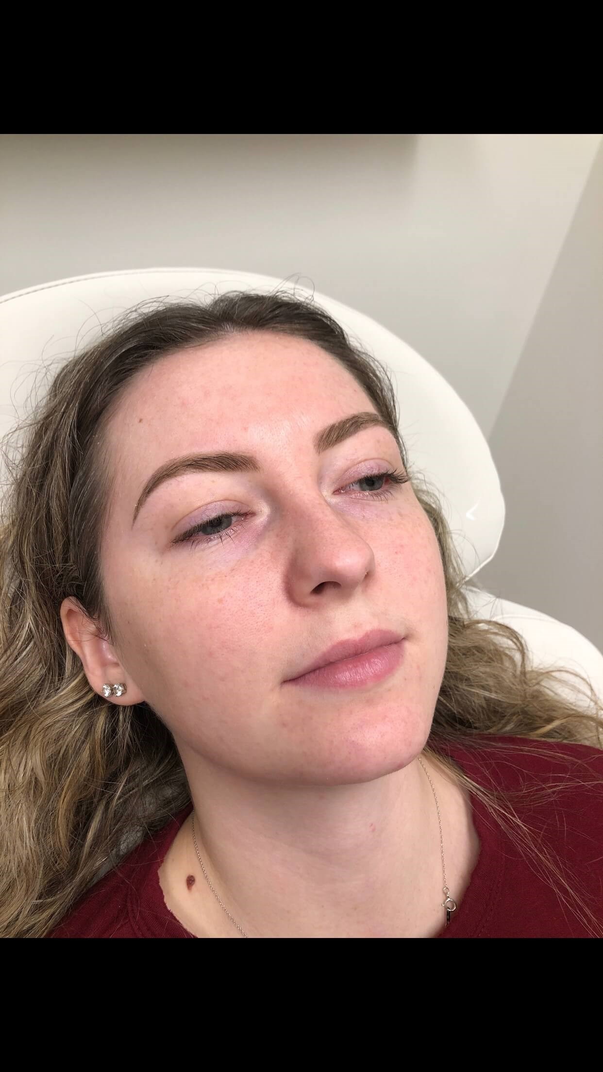 Juvederm Ultra lip fillers Before