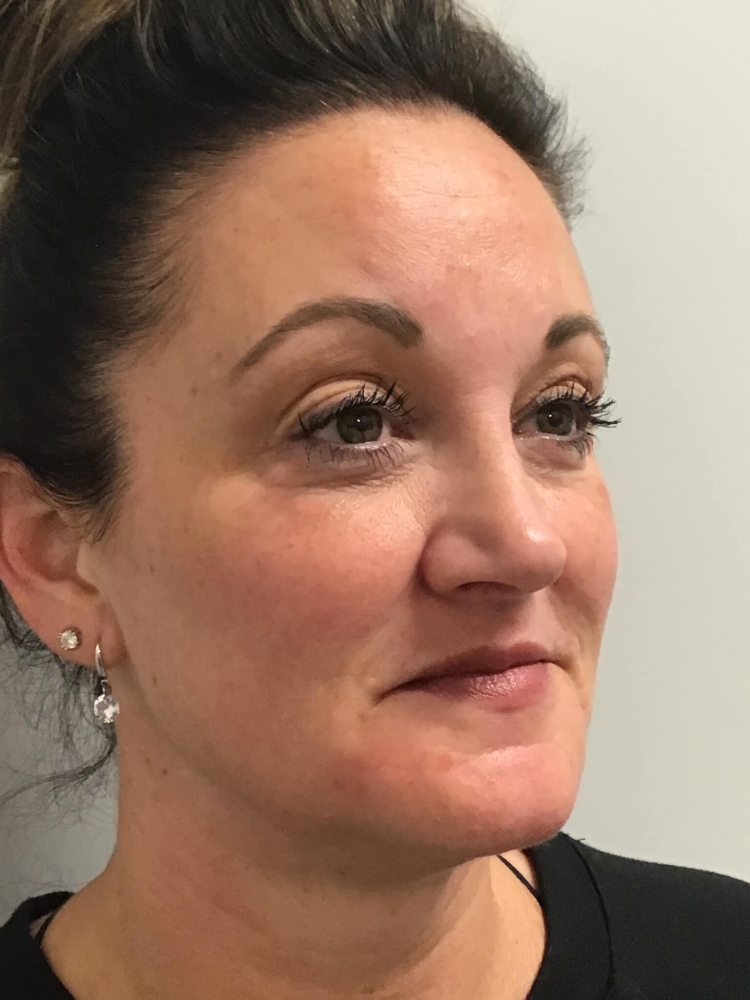 Juvederm Face Enhancement After