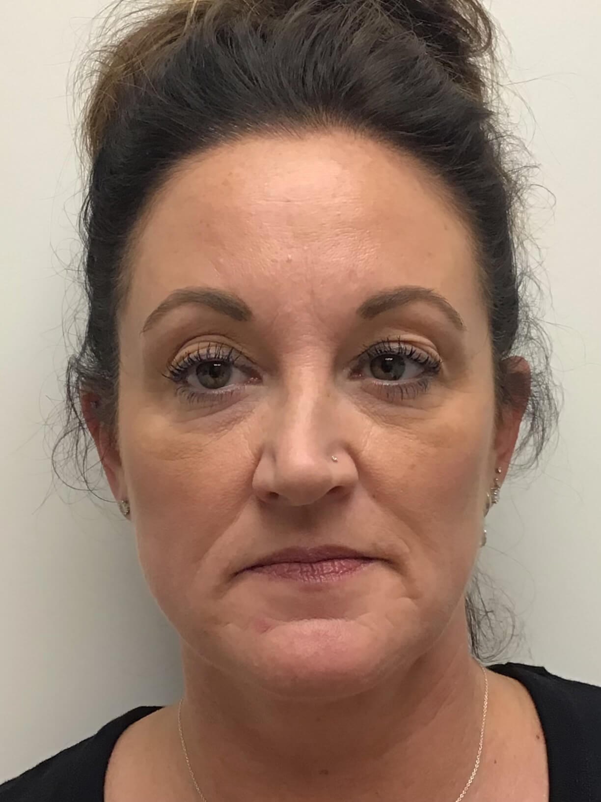 Juvederm Face Enhancement Before