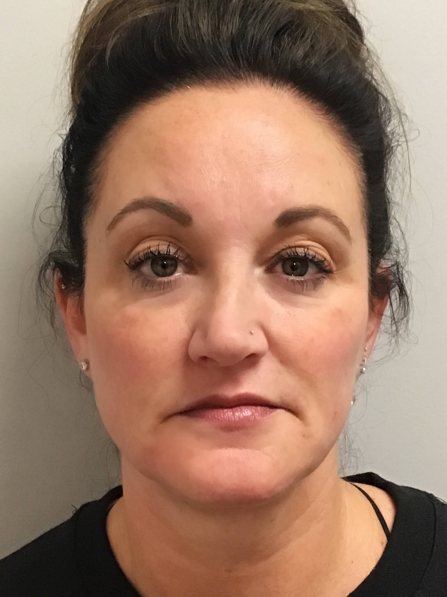 Juvederm Face Enhancement After