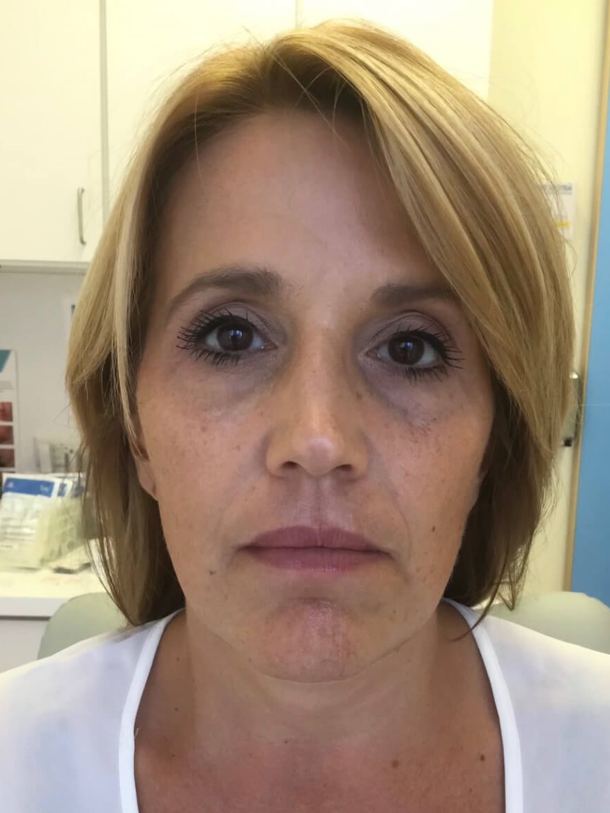 Juvederm Face Enhancement Before