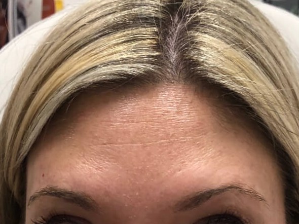 botox forehead After