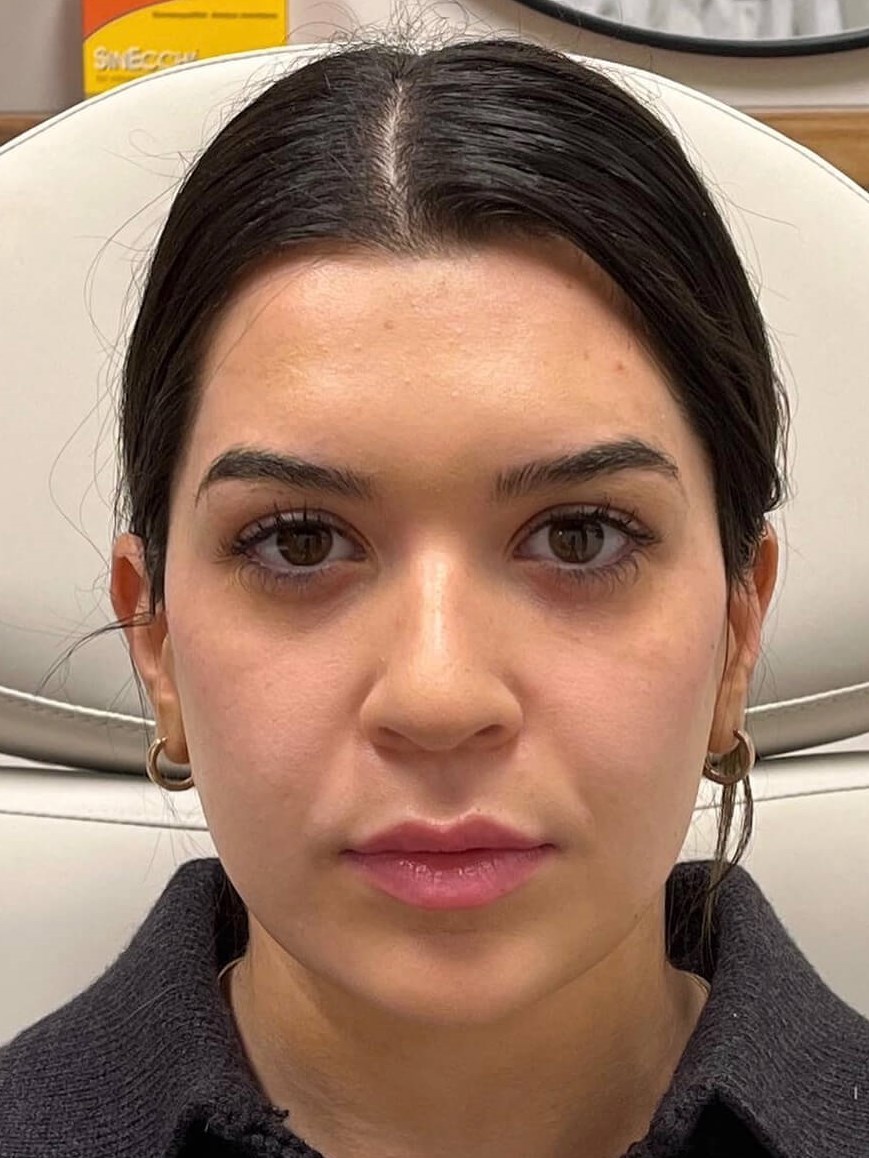 Juvederm Face Enhancement After