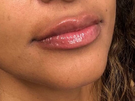 Juvederm Lip Enhancement After