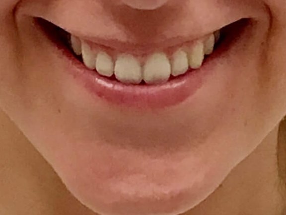 Gummy Smile Correction After