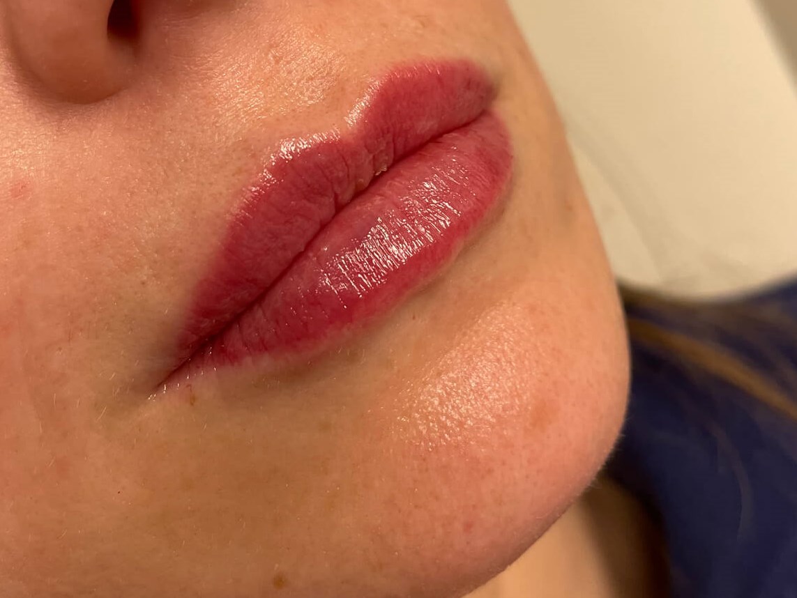 Juvederm Lip Enhancement After