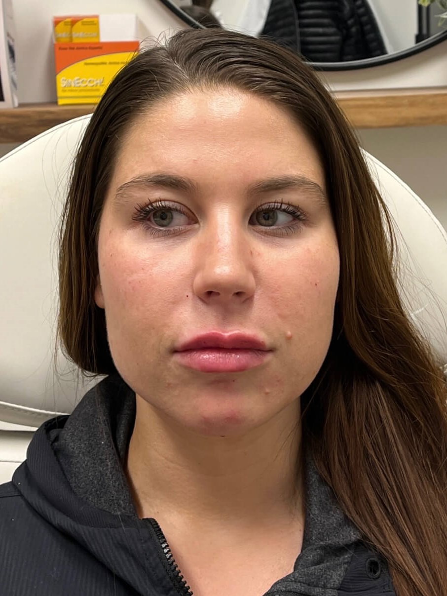 Restylane Face Enhancement After