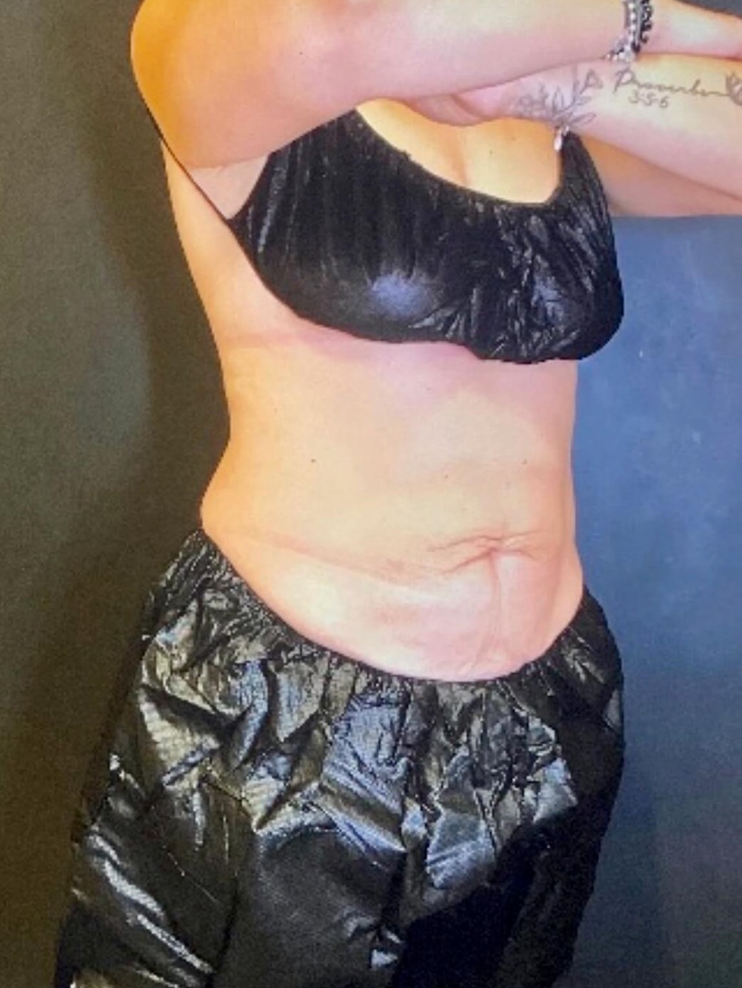 CoolSculpting Abdomen After