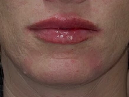 Juvederm Lip fillers After