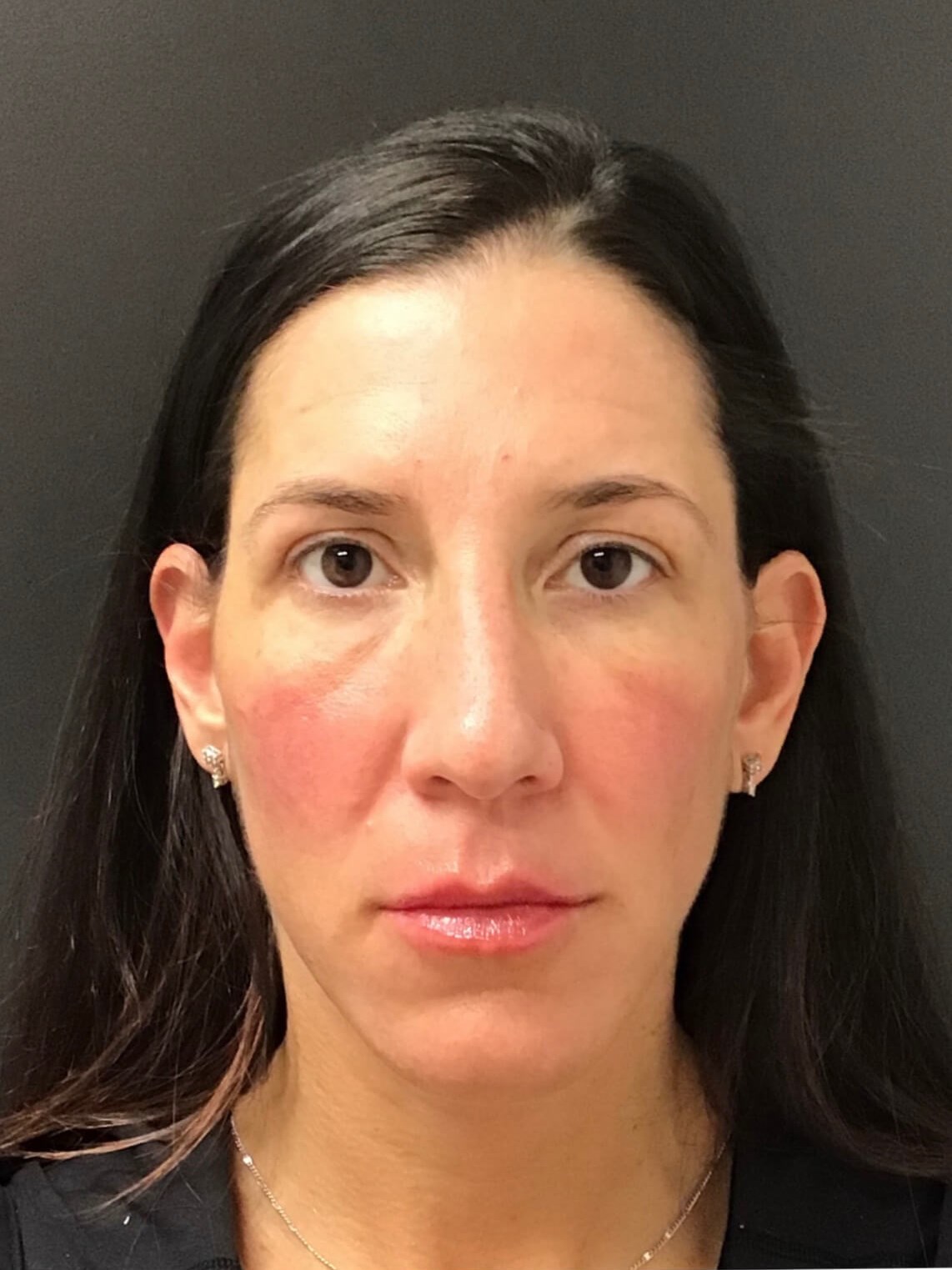 Juvederm Face Enhancement After