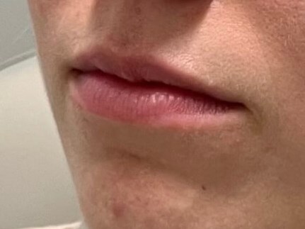 Juvederm Lip Enhancement Before