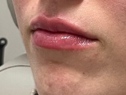 Juvederm Lip Enhancement After