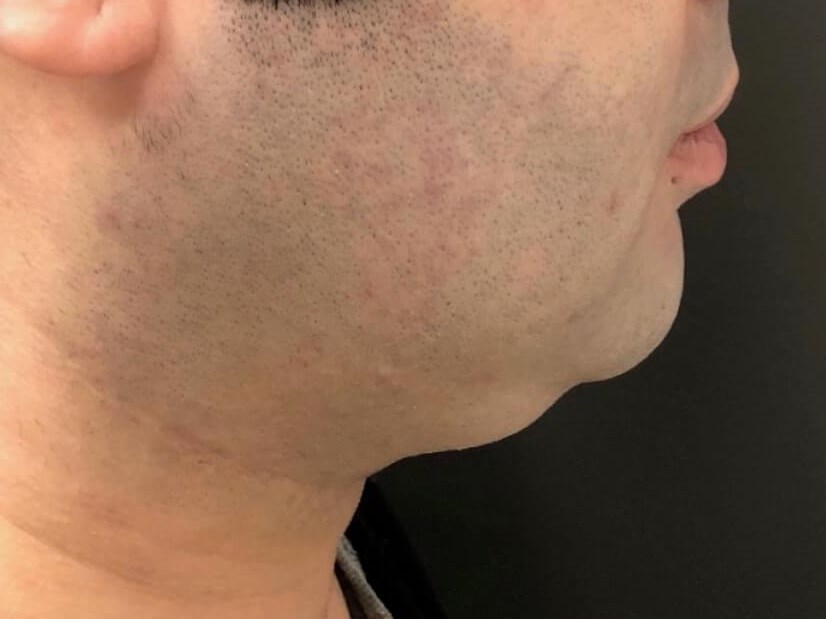 Kybella Chin Treatment Before