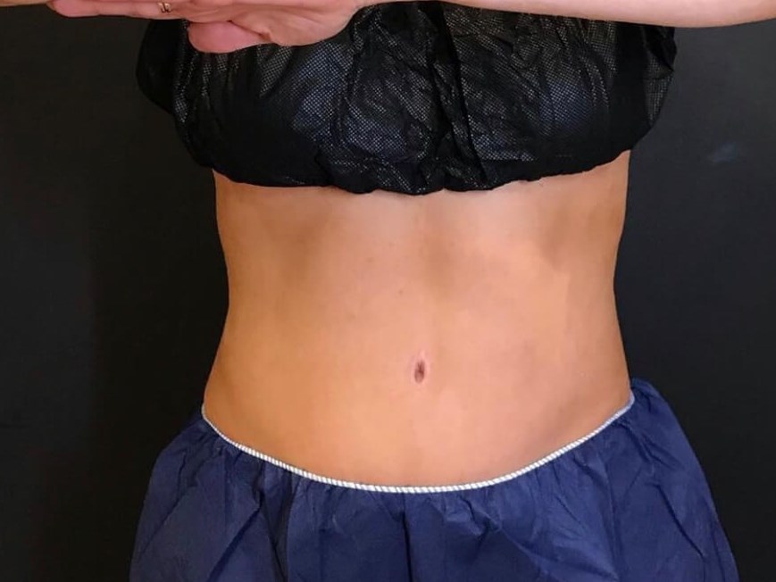 CoolSculpting Flanks After