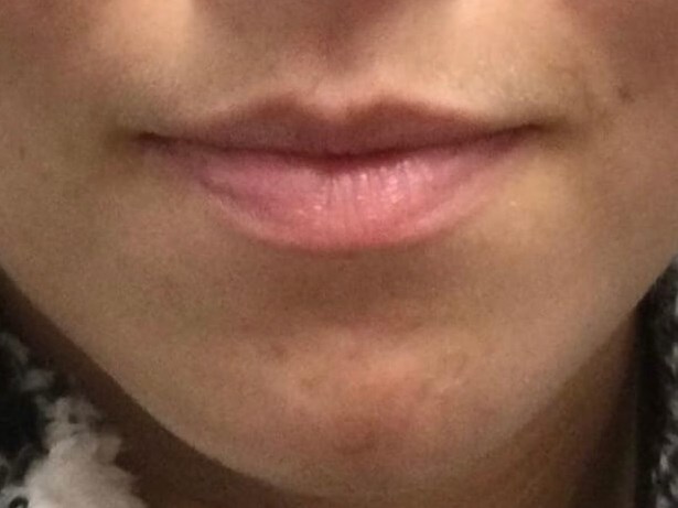 Juvederm Lip Enhancement Before