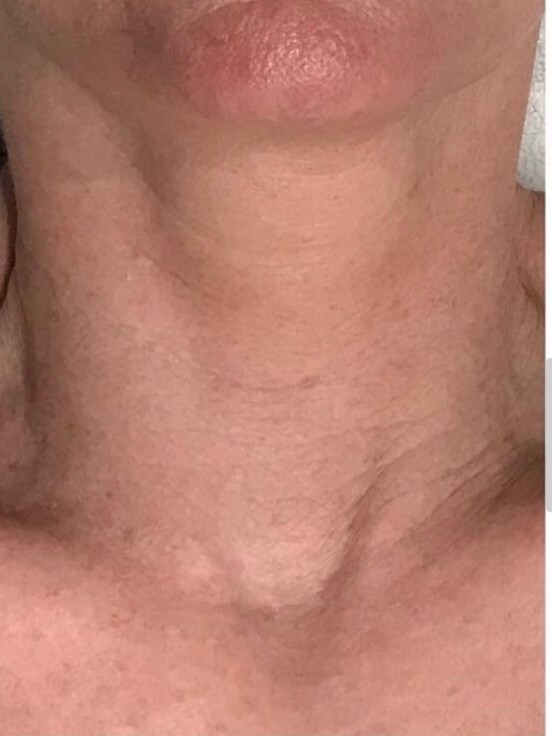 Exilis Skin Tightening Neck After