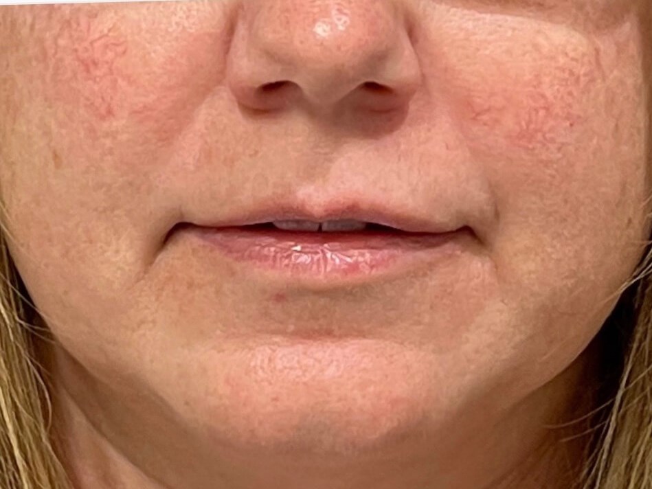 Photo Facial Before