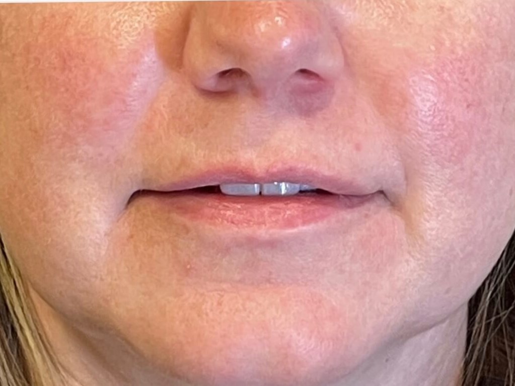 Photo Facial After