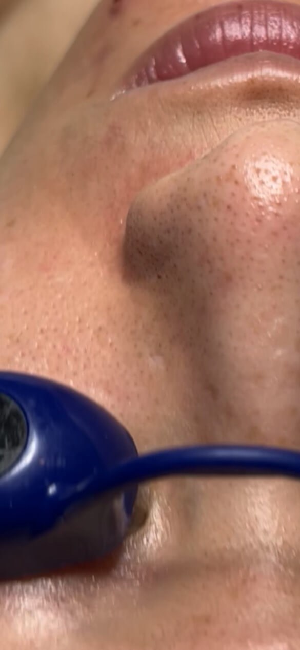 Diamond Glow Facial Before
