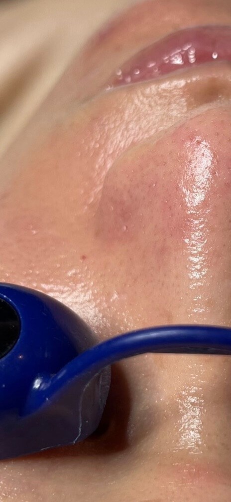 Diamond Glow Facial After