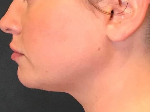 Kybella Submental Fullness After