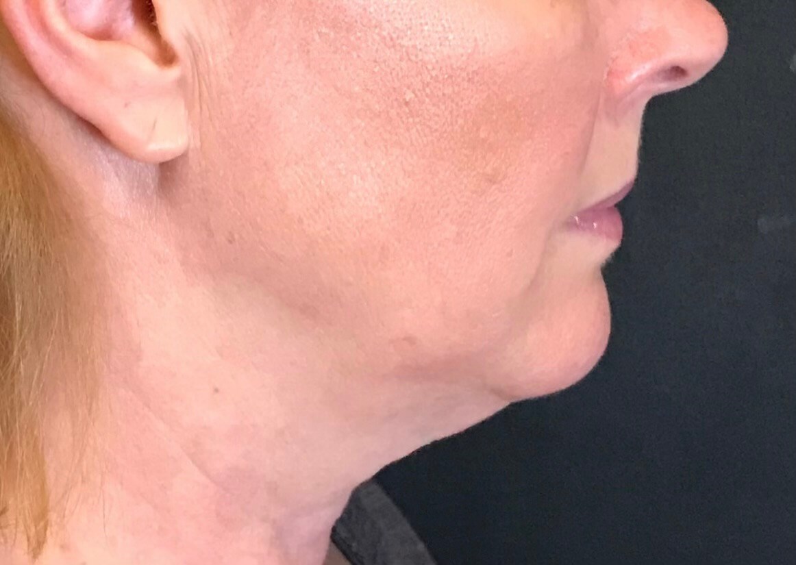CoolSculpting  Chin area Before