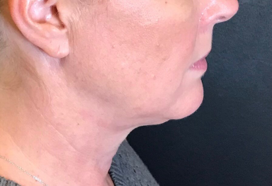 CoolSculpting  Chin area After