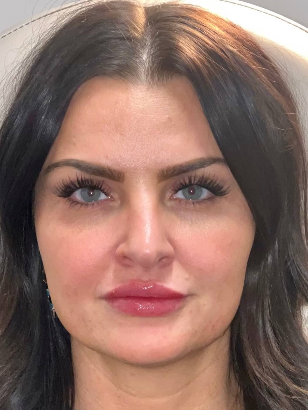 Juvederm Lip Enhancement After