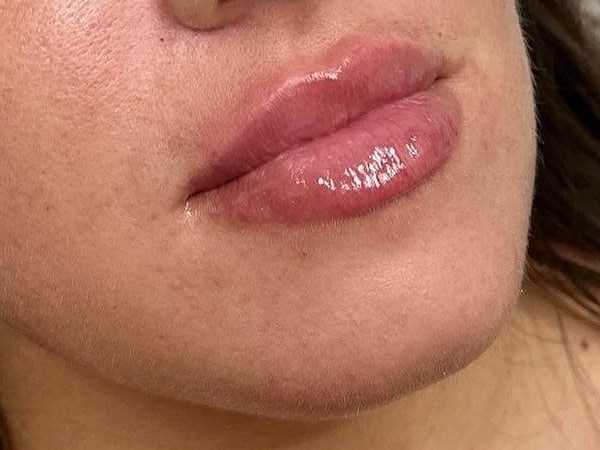 Juvederm Lip Enhancement After