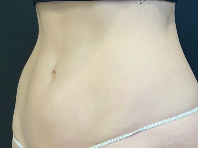 CoolSculpting Abdomen After