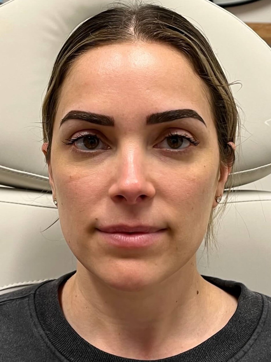 Juvederm Face Enhancement Before