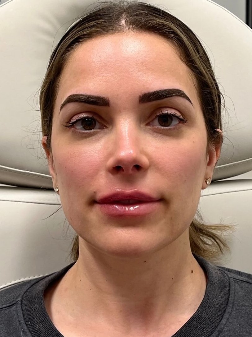 Juvederm Face Enhancement After