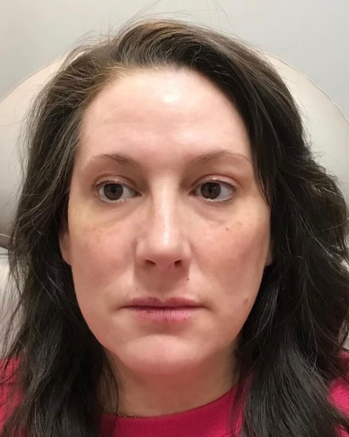 Juvederm Face Enhancement After