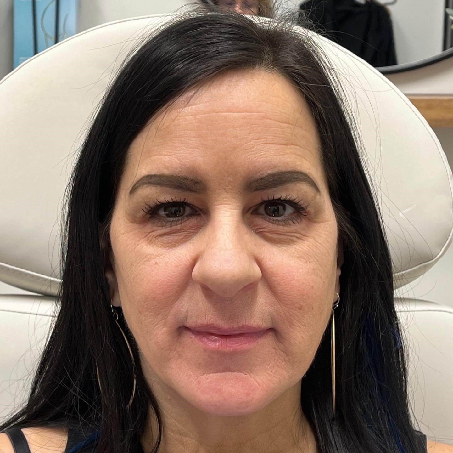 Juvederm Face Enhancement Before