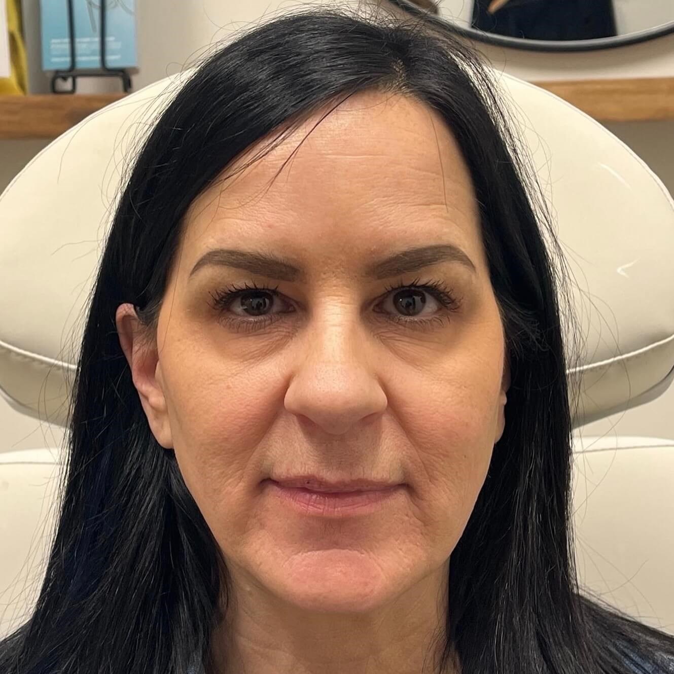 Juvederm Face Enhancement After