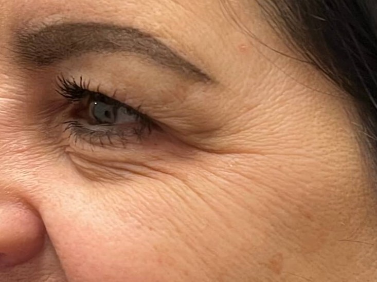 Botox crow's feet Before
