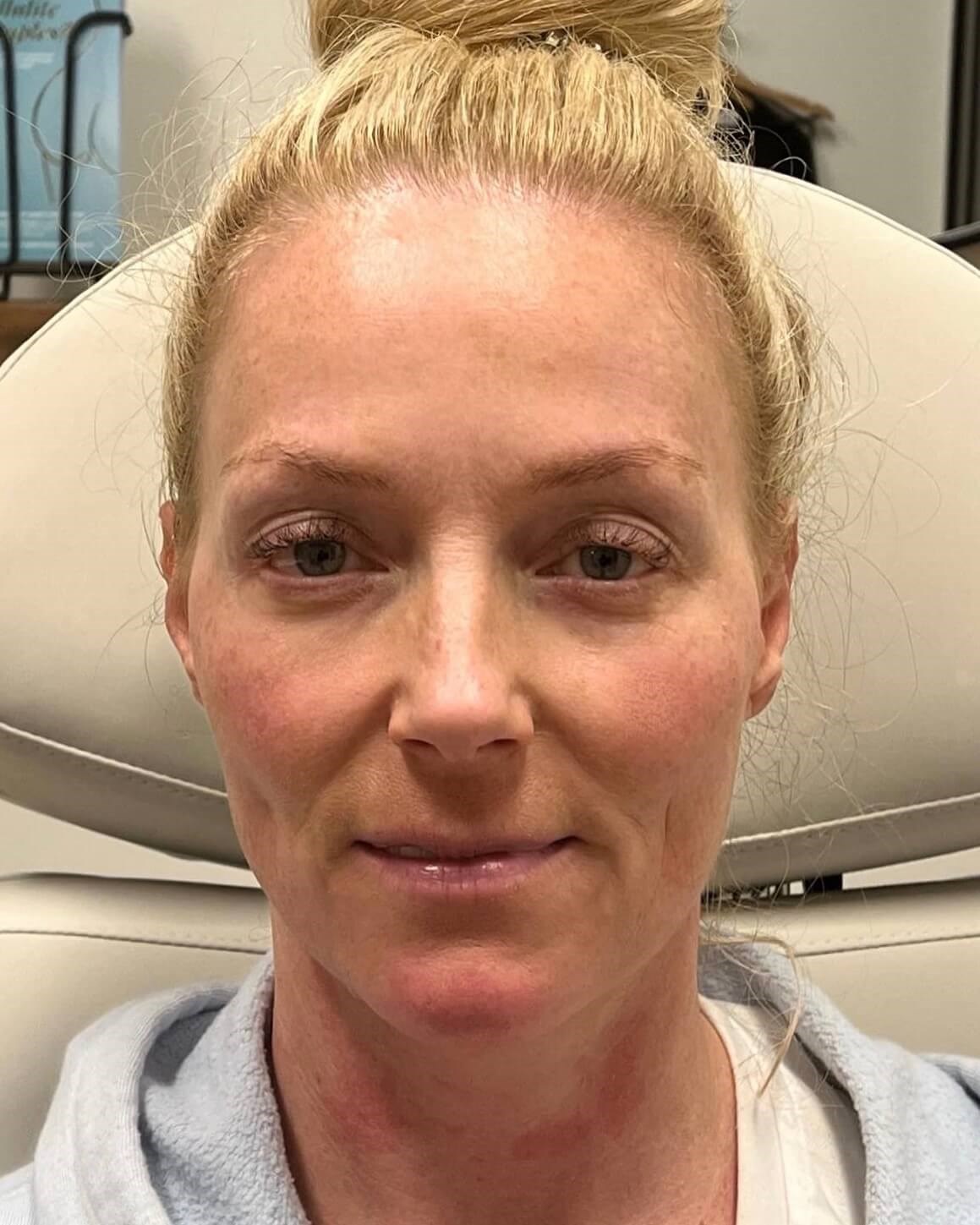 Juvederm Face Enhancement After